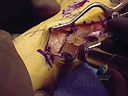 هندسة جراحة ماو لتصحيح عظم المشط الأول