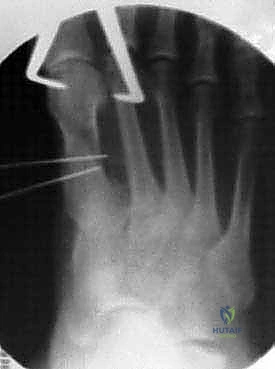 صورة توضيحية لـ جراحة عظمة إبهام القدم الأروح بتقنية ماو: حل متقدم للورم الملتهب مع الأستاذ الدكتور محمد هطيف