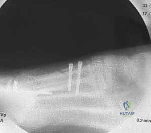 أسباب وأعراض تشوه إبهام القدم الأروح