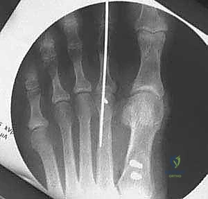 تحرير الأنسجة الرخوة حول المفصل