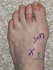 قصة نجاح مريض بعد جراحة الورم الملتهب