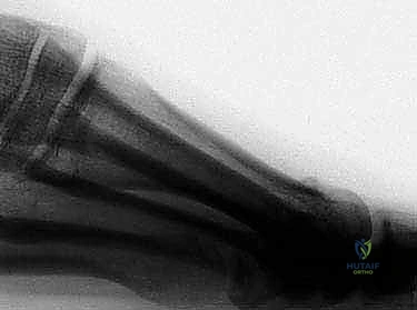 تثبيت العظم باستخدام براغي التيتانيوم