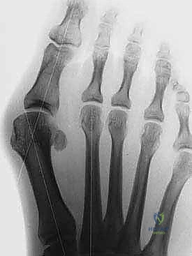 الإغلاق التجميلي للجرح