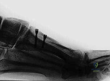 صورة توضيحية لـ جراحة عظمة إبهام القدم الأروح بتقنية ماو: حل متقدم للورم الملتهب مع الأستاذ الدكتور محمد هطيف