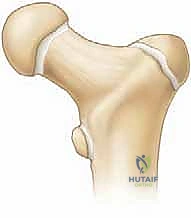 مراكز النمو في عظمة الفخذ