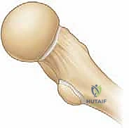 أسباب كسور الورك عند الأطفال