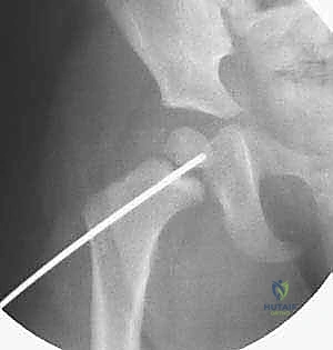 تشخيص كسور الورك بالأشعة