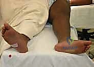 التثبيت الداخلي بالمسامير