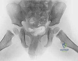 التشريح الدقيق لورك الطفل النامي
