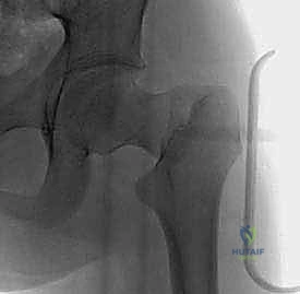 الخيارات الجراحية لكسور الأطفال