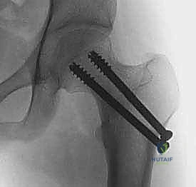 النخر اللاوعائي لرأس الفخذ
