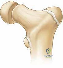 عدم التئام كسر الورك