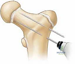 تضرر صفائح النمو