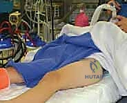 صورة توضيحية لـ كسور الورك عند الأطفال: دليل شامل للعلاج المتخصص والتعافي مع الأستاذ الدكتور محمد هطيف