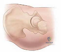 تصنيف ديلبيت لكسور الورك