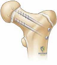 صورة توضيحية لـ كسور الورك عند الأطفال: دليل شامل للعلاج المتخصص والتعافي مع الأستاذ الدكتور محمد هطيف