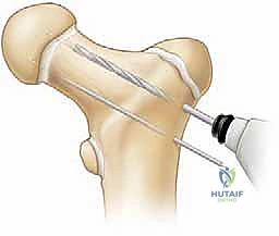 صورة توضيحية لـ كسور الورك عند الأطفال: دليل شامل للعلاج المتخصص والتعافي مع الأستاذ الدكتور محمد هطيف