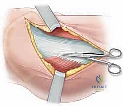 الأعراض السريرية لكسر الورك