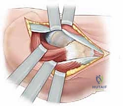 صورة توضيحية لـ كسور الورك عند الأطفال: دليل شامل للعلاج المتخصص والتعافي مع الأستاذ الدكتور محمد هطيف