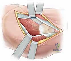 صورة توضيحية لـ كسور الورك عند الأطفال: دليل شامل للعلاج المتخصص والتعافي مع الأستاذ الدكتور محمد هطيف
