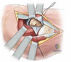 تشوه الورك للداخل