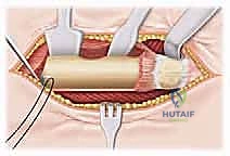 صورة توضيحية لـ كسور الورك عند الأطفال: دليل شامل للعلاج المتخصص والتعافي مع الأستاذ الدكتور محمد هطيف