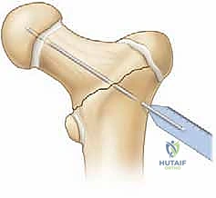 إغلاق الجرح التجميلي