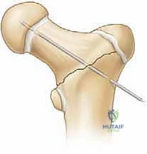 صورة توضيحية لـ كسور الورك عند الأطفال: دليل شامل للعلاج المتخصص والتعافي مع الأستاذ الدكتور محمد هطيف
