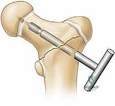 العلاج التحفظي والجبس