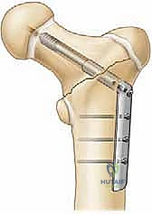 Pediatric Hip Fractures: An Intraoperative Masterclass in Reduction and Fixation