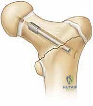 صورة توضيحية لـ كسور الورك عند الأطفال: دليل شامل للعلاج المتخصص والتعافي مع الأستاذ الدكتور محمد هطيف