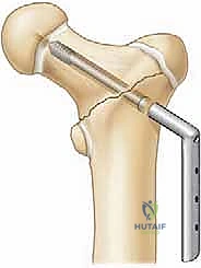 صورة توضيحية لـ كسور الورك عند الأطفال: دليل شامل للعلاج المتخصص والتعافي مع الأستاذ الدكتور محمد هطيف