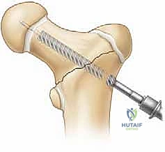 صورة توضح الإمداد الدموي في ورك الطفل