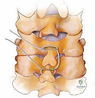التشخيص الدقيق والتصوير المقطعي للفقرات العنقية