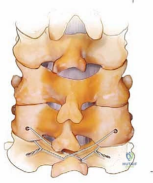الشق الجراحي والوصول إلى الفقرات العنقية من الخلف