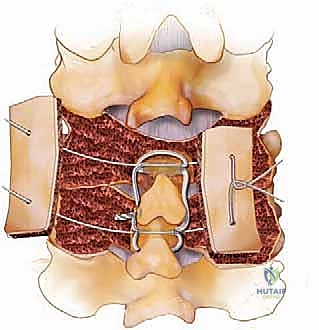 التخطيط ما قبل الجراحة والقياسات الدقيقة للبراغي