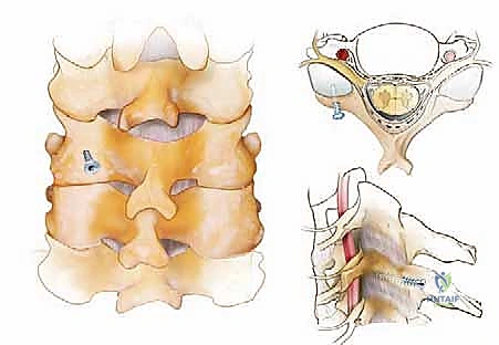 دمج الفقرات العنقية الخلفي: استعادة استقرار الرقبة وتخفيف الألم مع الأستاذ الدكتور محمد هطيف