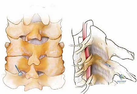 صورة توضيحية لـ دمج الفقرات العنقية الخلفي: استعادة استقرار الرقبة وتخفيف الألم مع الأستاذ الدكتور محمد هطيف