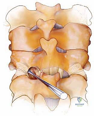 مرحلة التعافي والعلاج الطبيعي بعد جراحة دمج الفقرات