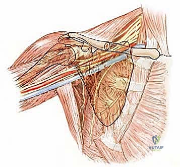 Illustration of proximal humerus resection - Dr. Mohammed Hutaif