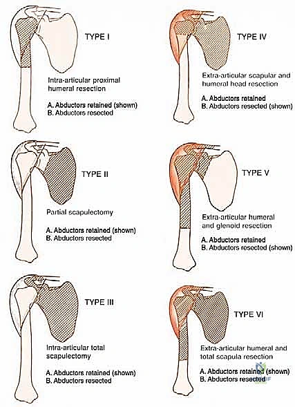 تأثير الأورام على الهيكل العظمي للكتف