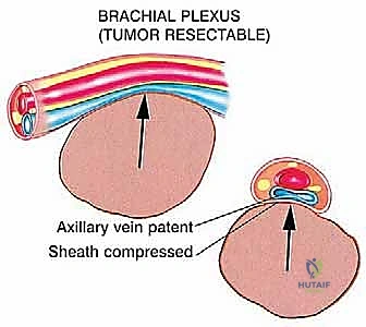 فحص سريري لتورم في منطقة الكتف