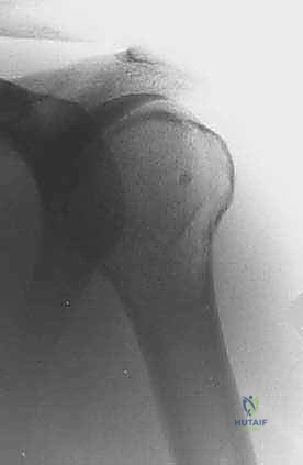 صورة توضيحية لـ استئصال العضد الداني وإعادة البناء بالطرف الاصطناعي