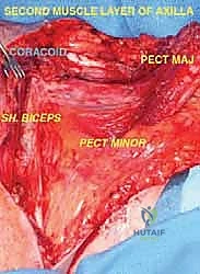 صور رنين مغناطيسي وأشعة مقطعية توضح امتداد الورم