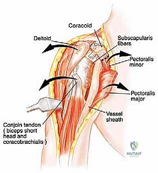 صورة طبية: استئصال العضد الداني وإعادة البناء بالطرف الاصطناعي: دليل شامل لمرضى أورام الكتف مع الأستاذ الدكتور محمد هطيف في صنعاء