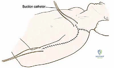 صورة طبية: استئصال العضد الداني وإعادة البناء بالطرف الاصطناعي: دليل شامل لمرضى أورام الكتف مع الأستاذ الدكتور محمد هطيف في صنعاء