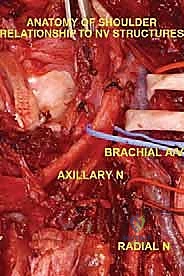 صورة طبية: استئصال العضد الداني وإعادة البناء بالطرف الاصطناعي: دليل شامل لمرضى أورام الكتف مع الأستاذ الدكتور محمد هطيف في صنعاء