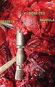 صورة توضيحية لـ استئصال العضد الداني وإعادة البناء بالطرف الاصطناعي: دليل شامل لمرضى أورام الكتف مع الأستاذ الدكتور محمد هطيف في صنعاء