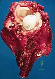 صورة توضيحية لـ استئصال العضد الداني وإعادة البناء بالطرف الاصطناعي: دليل شامل لمرضى أورام الكتف مع الأستاذ الدكتور محمد هطيف في صنعاء