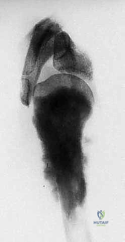 صورة توضيحية لـ استئصال العضد الداني وإعادة البناء بالطرف الاصطناعي: دليل شامل لمرضى أورام الكتف مع الأستاذ الدكتور محمد هطيف في صنعاء